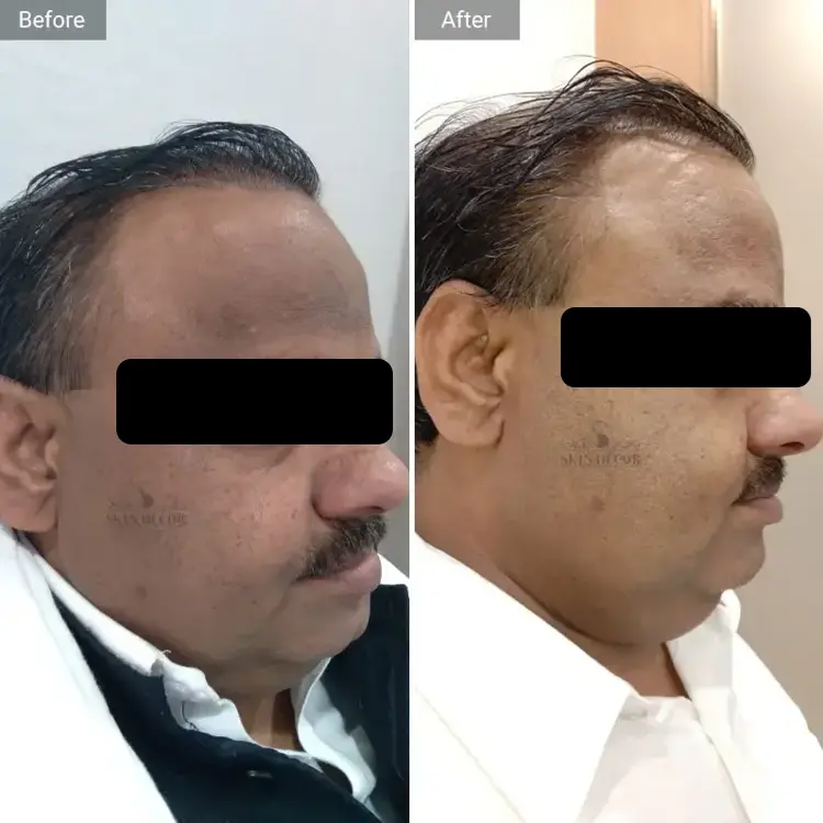 Face Rejuvenation Result #2