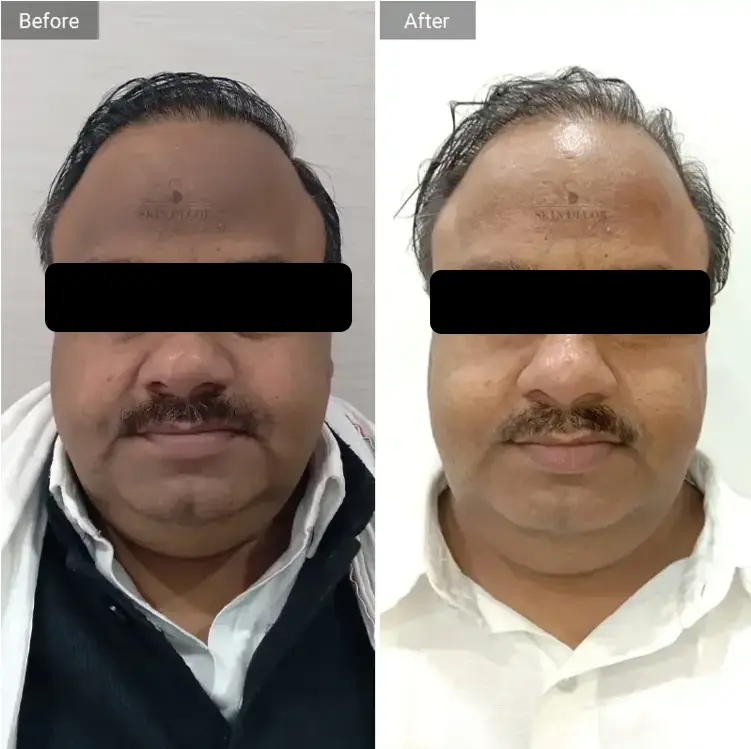 Face Rejuvenation Result #3